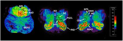 Nicotinic Receptors in the Brainstem Ascending Arousal System in SIDS With Analysis of Pre-natal Exposures to Maternal Smoking and Alcohol in High-Risk Populations of the Safe Passage Study